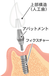 インプラント治療の症例